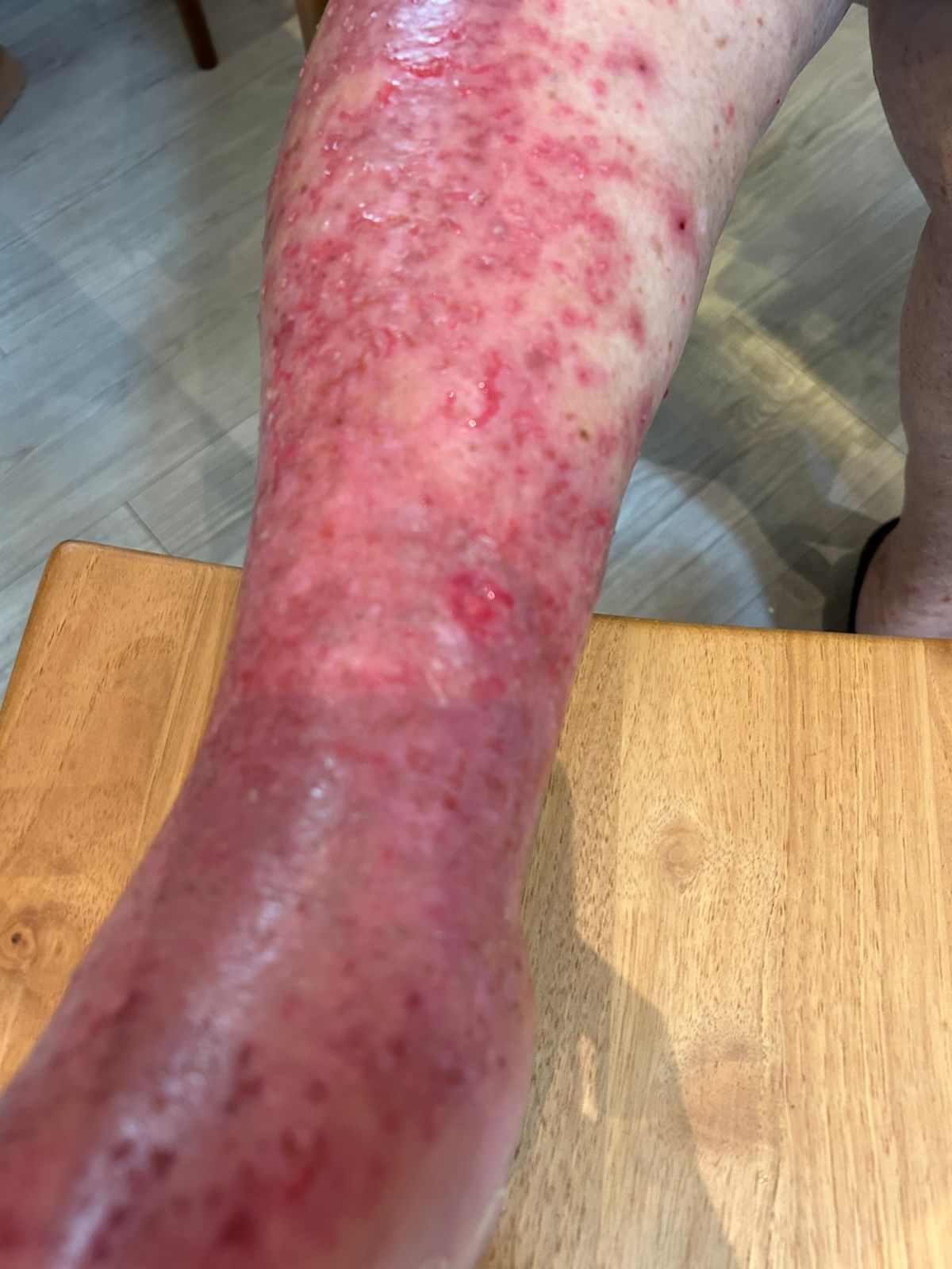 24/03/25, consulta vascular - Detalhe